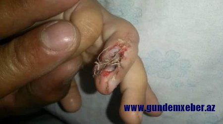 Növbəti həkim biabırçılığı - Uşağın ətini kəsib atdı - FOTO (+18)