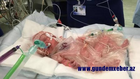 Uşağın ürəyinin yarısı çöldə doğuldu - FOTO+VIDEO