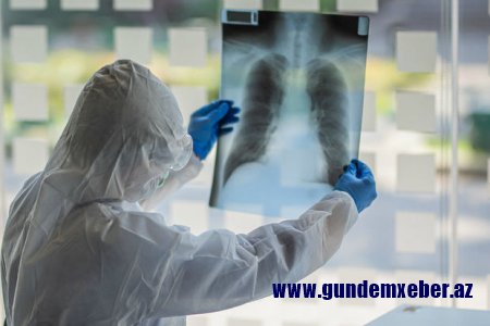 Buzlu şüşə diaqnozu qoyulan koronavirus xəstələri nə etməlidirlər? - Həkimdən AÇIQLAMA