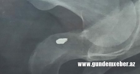 Xidmətə yazılan yaralı hərbiçi fəryad edir - TÜKÜRPƏDƏN MÜRACİƏT