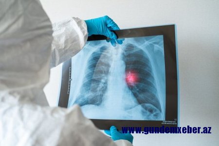 Koronavirusun daha çox zədələdiyi orqanlar açıqlandı