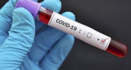 Daha 305 nəfər COVID-19-a yoluxub, 2 nəfər ölüb