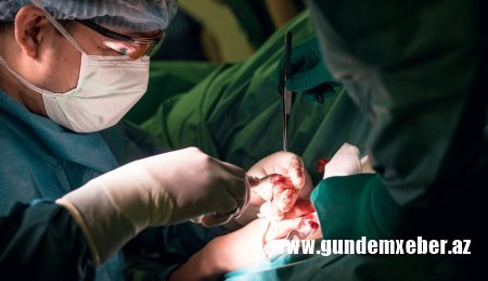 Rusiyada kişinin alnından 12 santimetrlik qurd çıxarıldı
